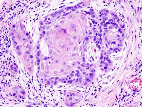 Cell Of Origin For Squamous Cell Carcinoma Discovered