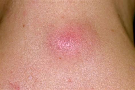 Infected Sebaceous Cyst Photograph By Dr P Marazziscience Photo Library
