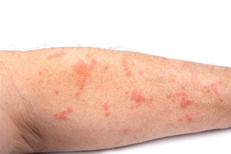 130 Scabies Rash Photos Stock Photos Pictures And Royalty Free Images