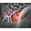 Colorectal Cancer Risk Factors Vary By GI Region  Gastroenterology Advisor