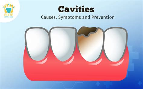 6 Cavities Causes Symptoms And Prevention Elite Dental Care