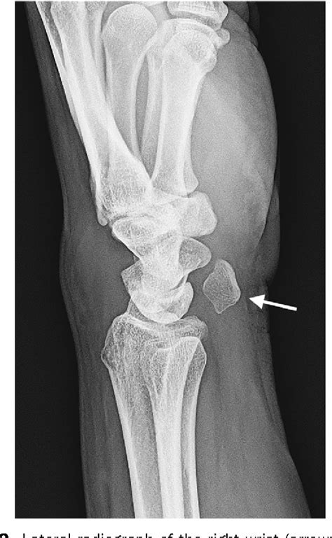 Figure From Woman With Wrist Pain After Falling Isolated Pisiform