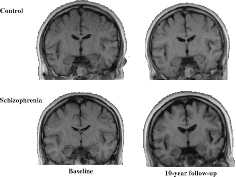 Figure 1 From A Review Of Mri Studies Of Progressive Brain Changes In