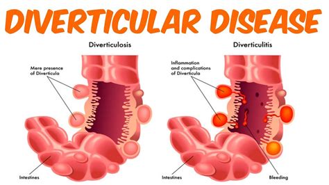 Diverticulosis And Diverticulitis Youtube