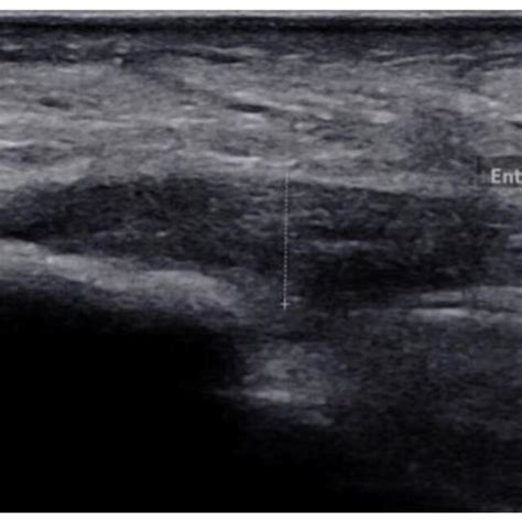 Longitudinal SWE Image And B Mode Ultrasound Image Of A Year Old Download Scientific Diagram
