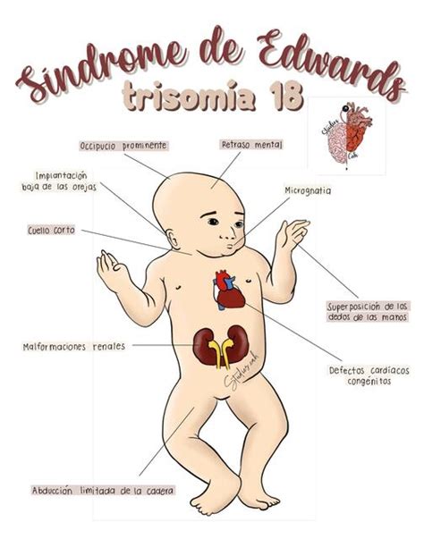 Síndrome de Edwards trisomía 18 Studiescah uDocz