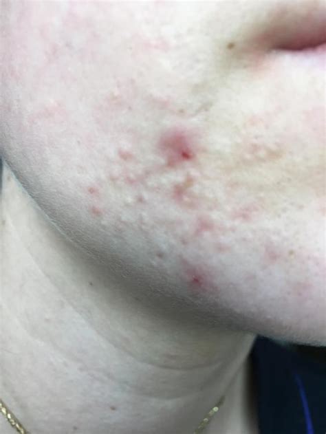 Small Flesh Colored Bumps On Forehead And Hairline Adult Acne Acne