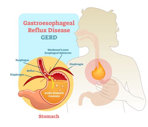Gastroesophageal Reflux Disease Gerd Symptoms Treatment
