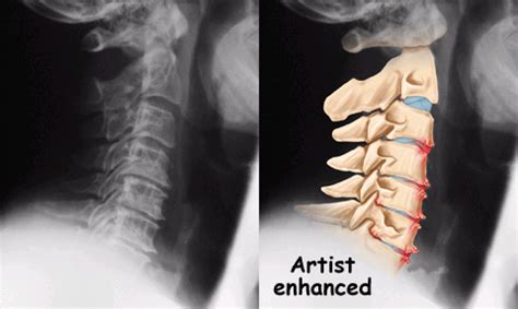 Causes of neck bone spurs (cervical osteophytes). Neck Pain | Singapore Sports & Orthopaedics Clinic