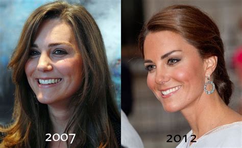 Waity2 Duchess Kate Botox Kate Middleton