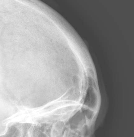Skull Vault Osteoma Radiology Reference Article Radiopaedia Org