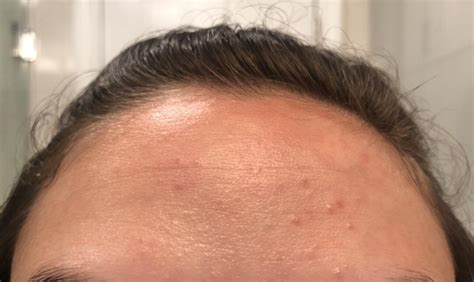 Skin Concerns Ive Had These Forehead Bumps Since About January I