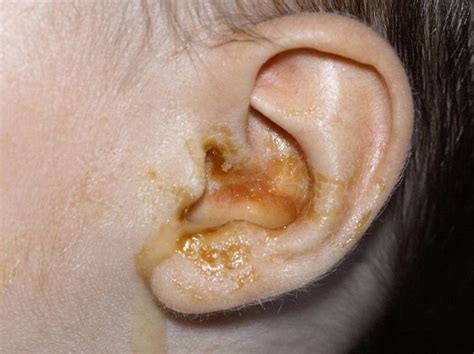 Ear Infections In Babies And Children Babycenter Baby Ear Infection