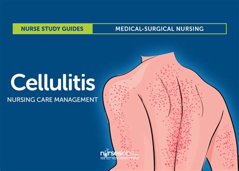 Cellulitis Nursing Care And Management Study Guide