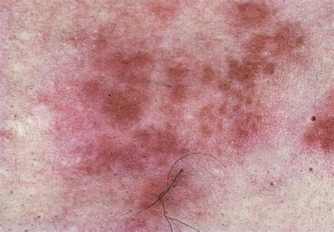 Shingles Rash From Herpes Zoster Infection Photograph By James