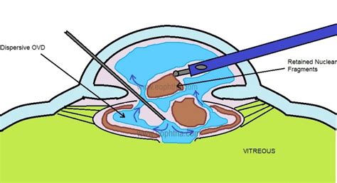 Anterior Vitrectomy Made Easy For Cataract Surgeon