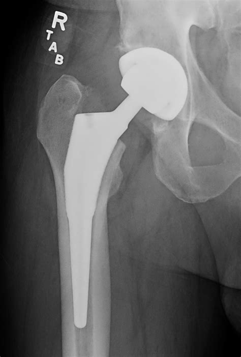 Outpatient Total Hip Replacement Seaside Surgery Center
