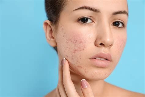 Acne Melbourne Skin Dermatology