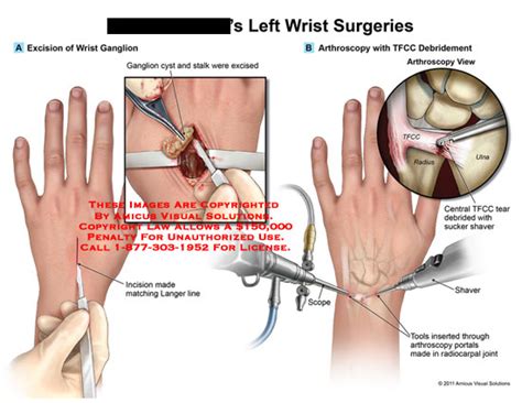 Amicus Illustration Of Amicus Surgery Wrist Excision Ganglion Cyst Stalk Excised Incision