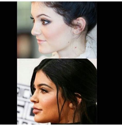 Kylie Jenner Plastic Surgery Profile View Chinjaw Surgery Nose Job