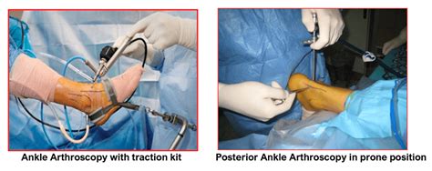 Ankle Arthroscopy Home Consultant Orthopaedic Surgeon
