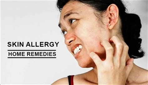 Top 10 Home Remedies To Get Rid Of Skin Allergies