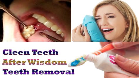 Most people between the ages of 17 and 24 begin to grow wisdom teeth. Wisdom Teeth Removal | How to Clean Your Teeth - After ...