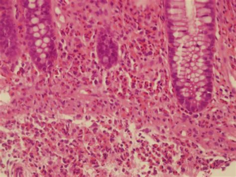 Figure 3 From Eosinophilic Gastroenteritis With Abdominal Pain And