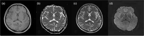 Brain Magnetic Resonance Imaging 5 Months After Discharge A Axial Download Scientific