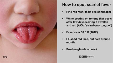 Scarlet Fever Cases Hit 50 Year High In England Bbc News