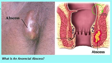 Anorectal Abscess Causes Risk Factors And Treatment Healthsoul Hot