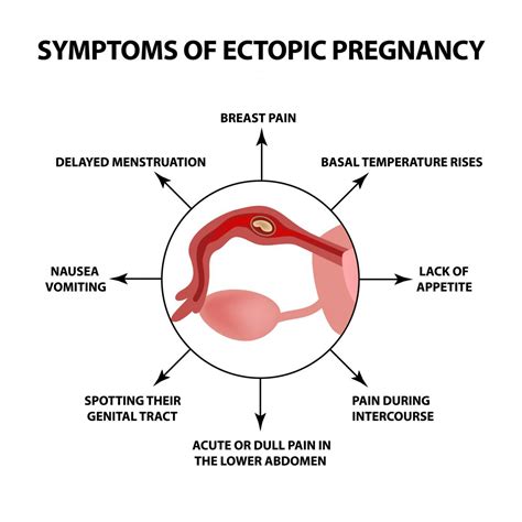 Ectopic Pregnancy Is A Medical Emergency Vuk Uzenzele