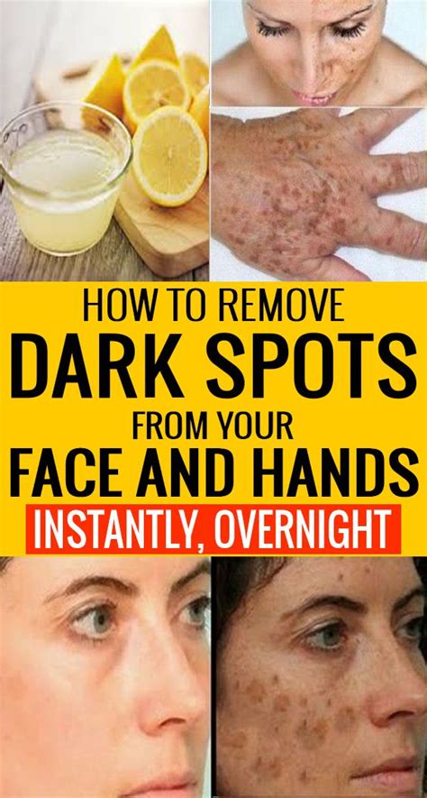 How To Remove Dark Spots On The Face Naturally Howotremvo
