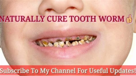 Naturally Remove And Cure Tooth Worm At 🏡how To Remove Teeth Worms Youtube