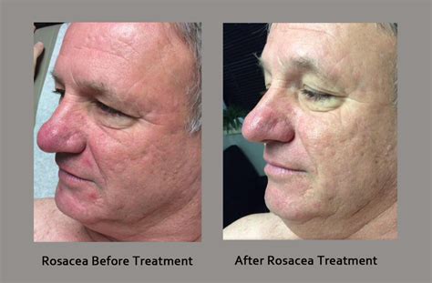 Rosacea Sun Exposure Uv And Rosacea Treatment