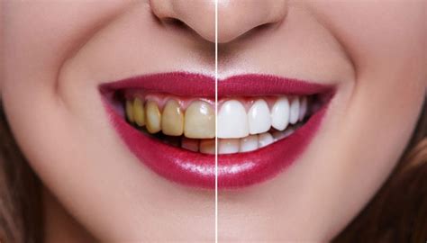 Dental Aesthetics How To Take Care Of Your Smile