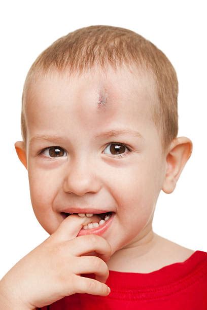 270 Forehead Bruise Stock Photos Pictures And Royalty Free Images Istock