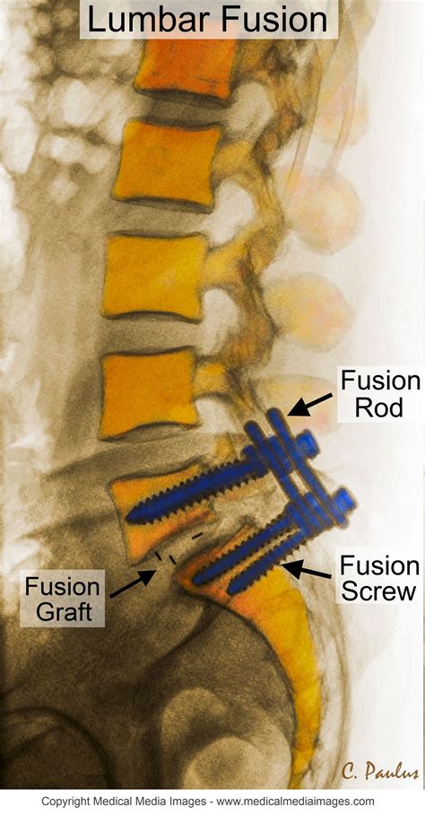 Lumbar Spine X Ray Anatomy