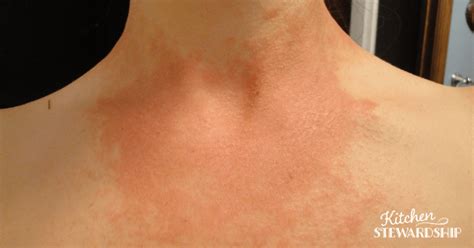 Breast Fungus Itchy Fungal Rash Causes Pictures