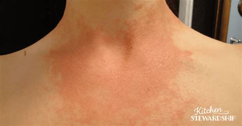 Candidiasis Rash