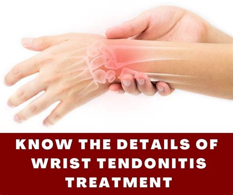 Know The Details Of Wrist Tendonitis Treatment Buildingbeast
