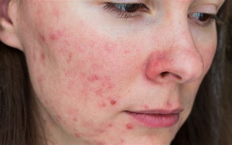 Spironolactone An Effective Treatment For Acne In Women The Pharmacist