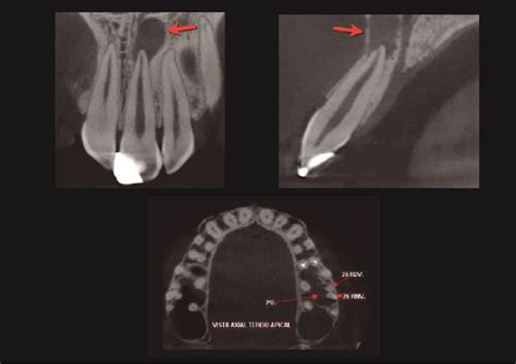 Tomograf A Computarizada Cone Beam En Endodoncia Cdi
