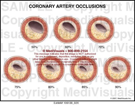 Coronary Artery Occlusions Medical Illustration Medivisuals
