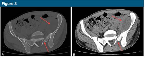 Figure 3 From Iliopsoas Abscess Presenting With Sacral Fracture And