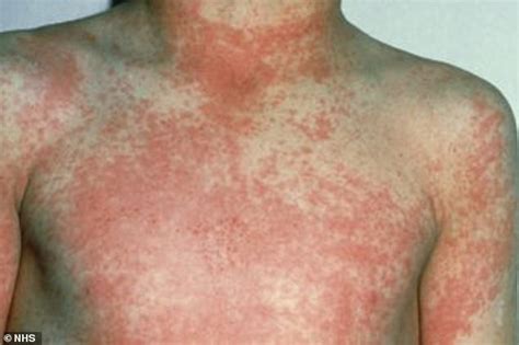 Britain Is In Grips Of Scarlet Fever Outbreak With 480 Children