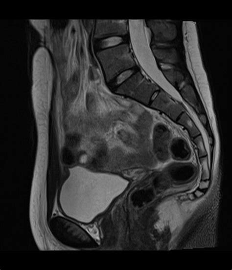 Mayer Rokitansky Küster Hauser Syndrome Type 1 Radiology Case