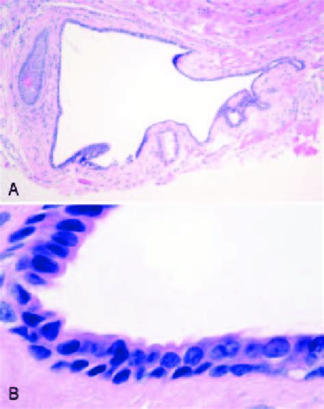 Histopathology Disclosed A Benign Eccrine Hidrocystoma The Cyst Has An