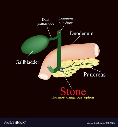 Stone Pancreatic Bile Duct The Gall Bladder Vector Image