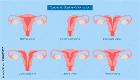 Abnormal Uterus Tipped Septum Missed Mature Cervix Double Absent Defect